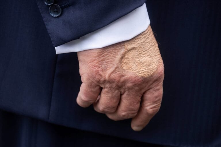 A new dark bruise on his hand. Health concerns about Trump